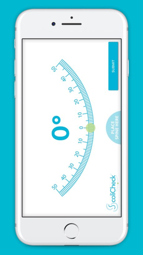 ScoliCheck Screenshot